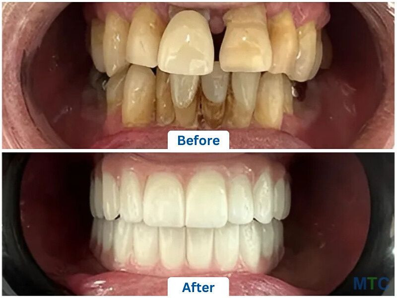 Dental Implants