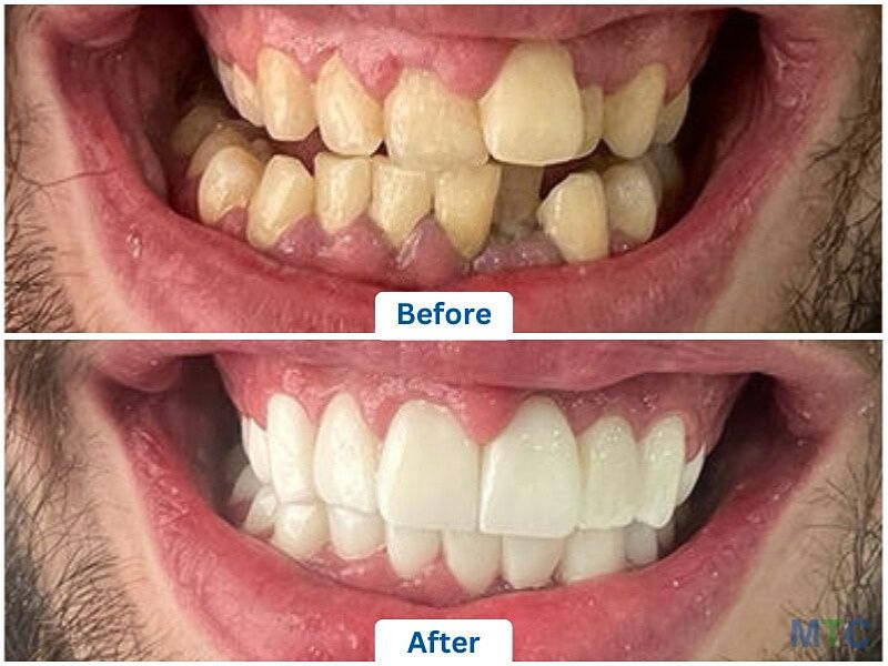 Dental Implants