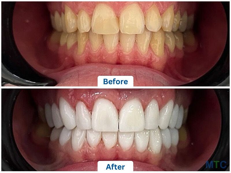 Dental Veneers