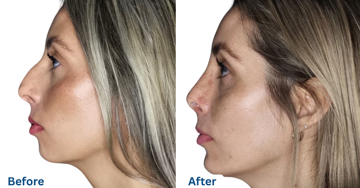 Cosmetic Surgery in Mexico