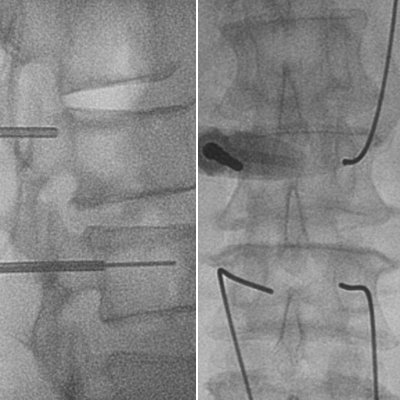 Intraoperative monitoring for spine surgery