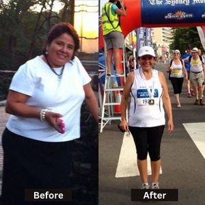 Before & After Results of Bariatric Surgery in Mexico