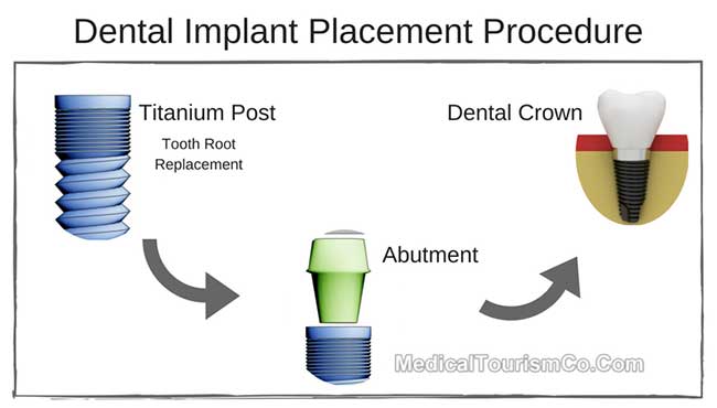 Dental Implants Procedure