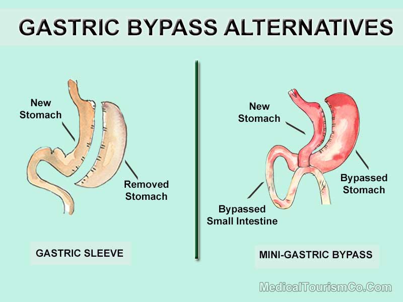 Gastric Bypass Alternatives