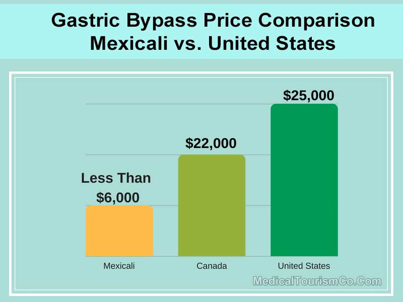 Gastric Bypass Price Comparison
