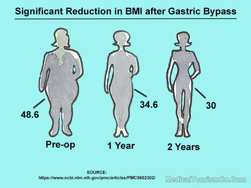 Reduction in BMI after Gastric Bypass