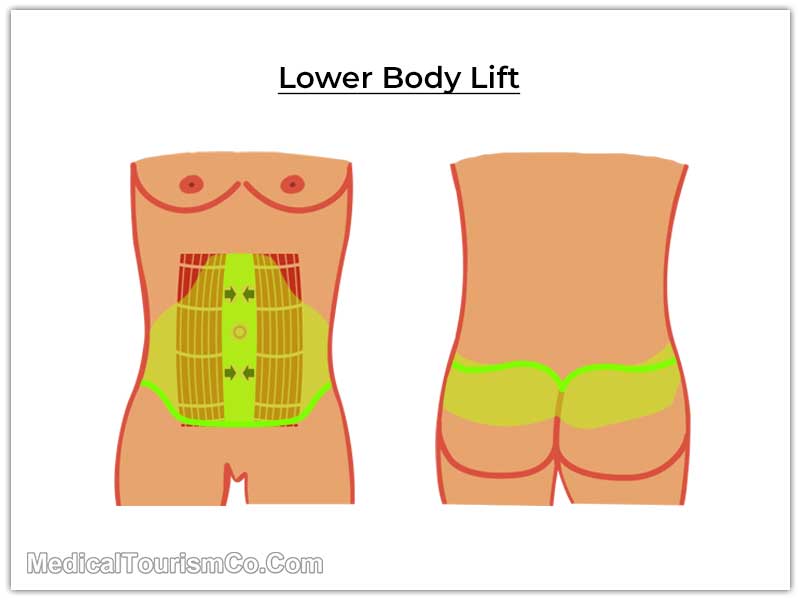 Lower-Body-Lift