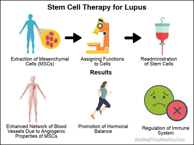 Stem Cell Therapy for Lupus in Mexico 