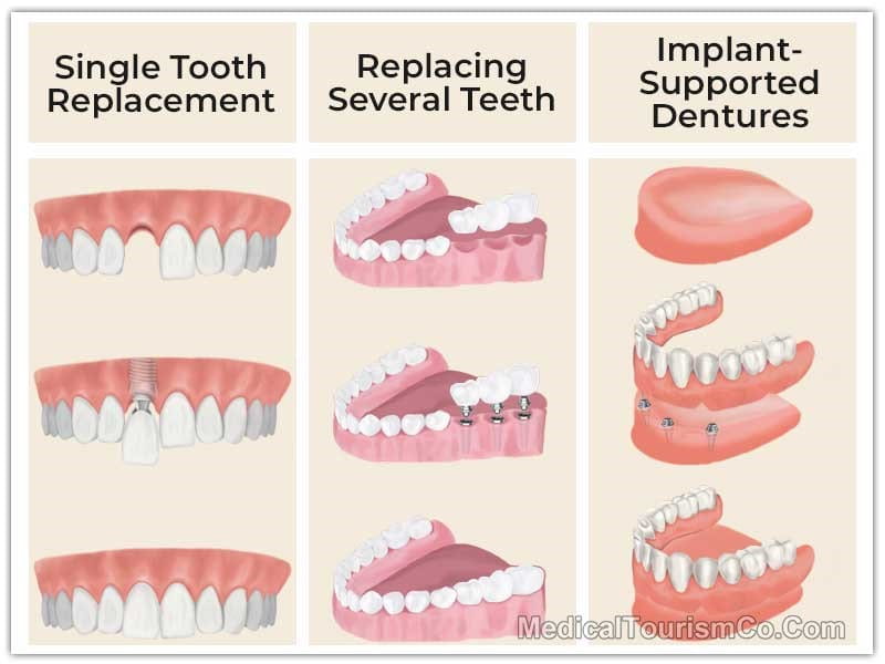 Different Types of Dental Implants