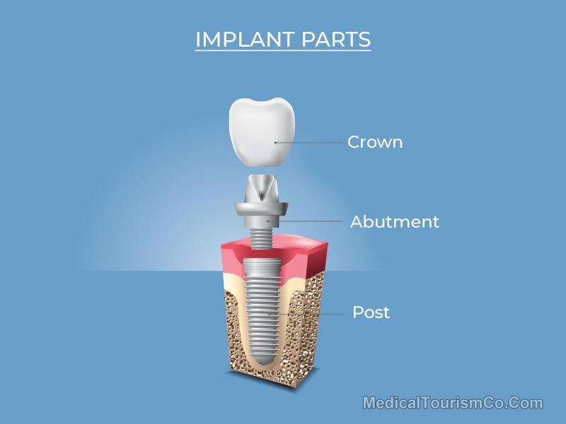 Dental Implant in Cambodia