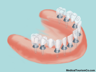 crown on implants