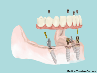 All-on-4 dental implants