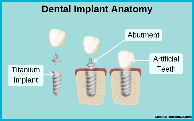 Dental Implant Illustration