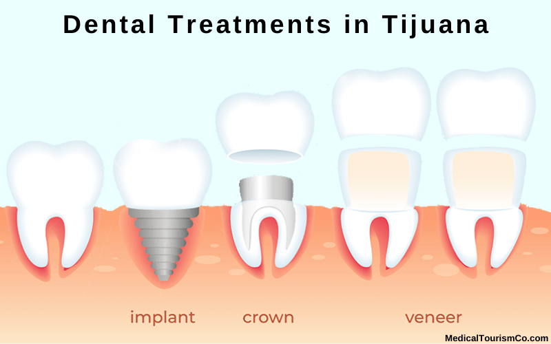 Dental Treatments in Tijuana