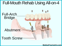 all on 4 full mouth implants- dental work