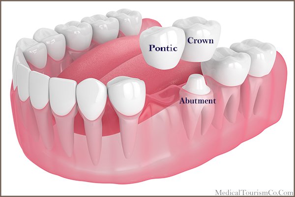 Tooth Supported Cantilever Bridge-Fixed Denture Abroad