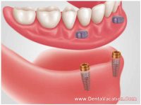 Snap-on Denture