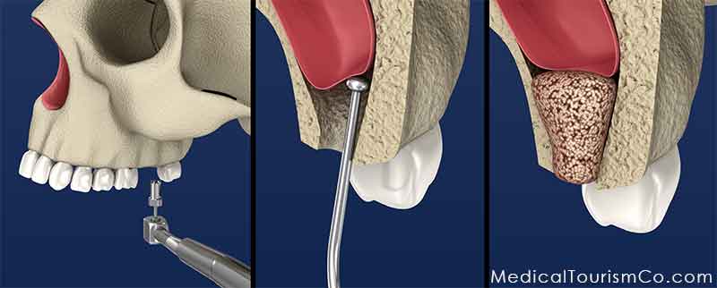 Dental Bone Graft in Mexico