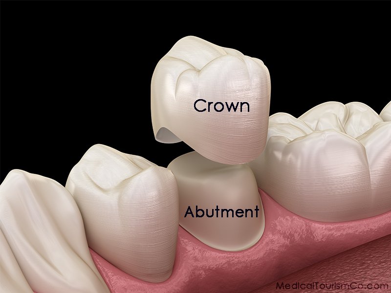 Dental Crown in Colombia