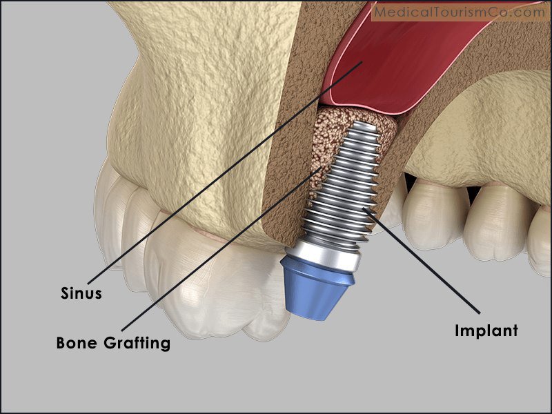 Sinus Lift