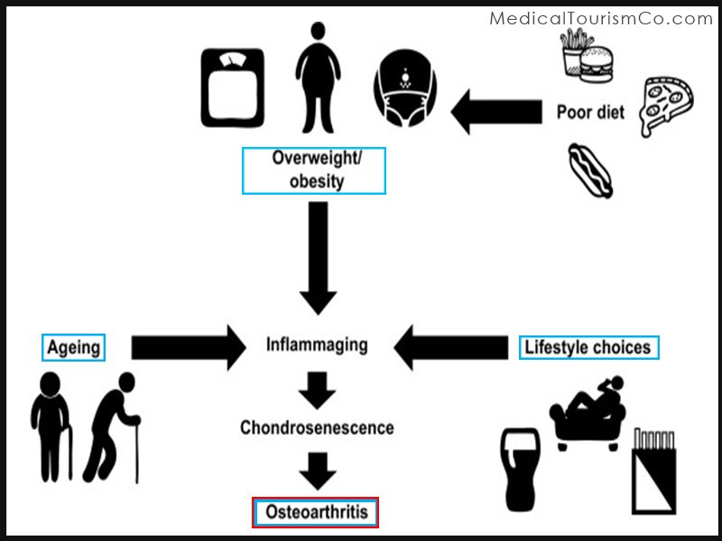 Causes for Osteoarthritis: Stem cell for osteoarthritis in India