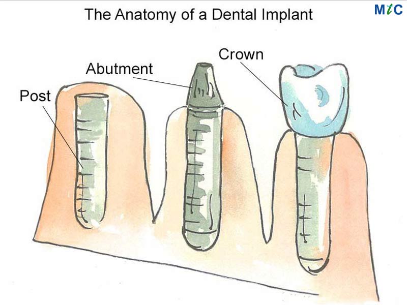 Dental implant anatomy