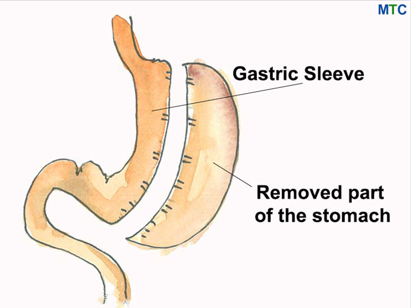 Gastric Sleeve Procedure