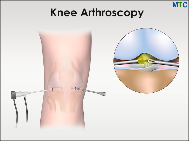 Knee Arthroscopy in Mexico