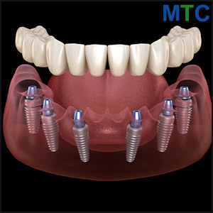 All on 6 Dental Implants