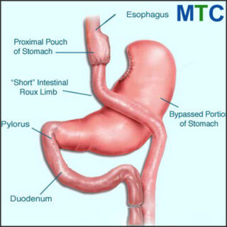 Gastric Bypass vs. Mini Gastric Bypass