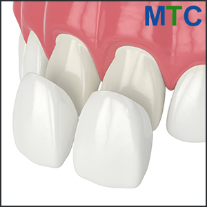 Composite veneers in Spain