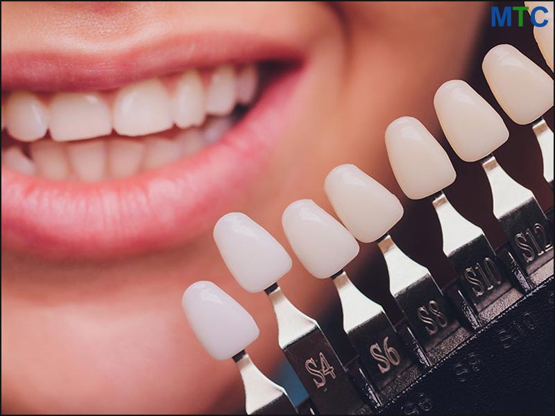 Dental Veneers in Spain