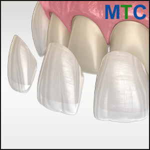 Porcelain Veneers, Puerto Rico