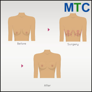 Breast augmentation in Tijuana