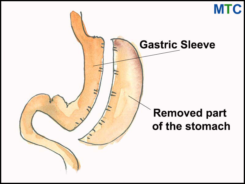 Sleeve Gastrectomy 