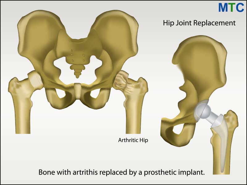 Hip Replacement in Izmir, Turkey