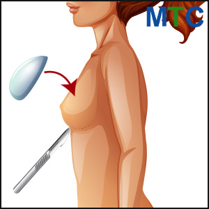 Breast implant in Tijuana, Mexico