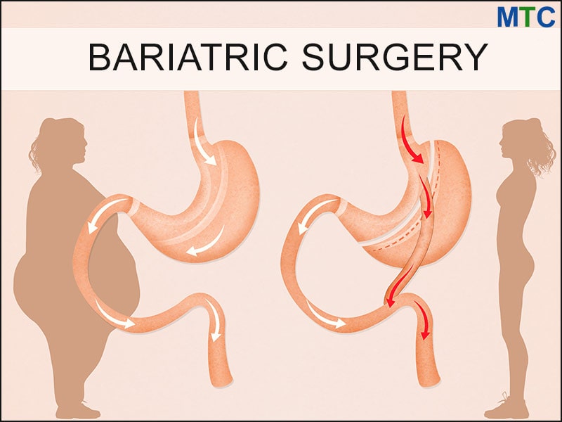 Bariatric Surgery