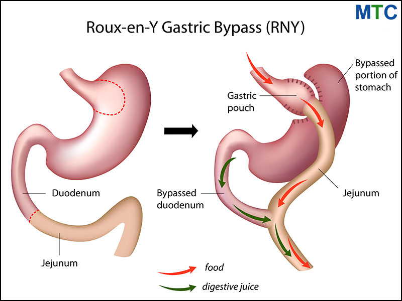 Gastric Bypass