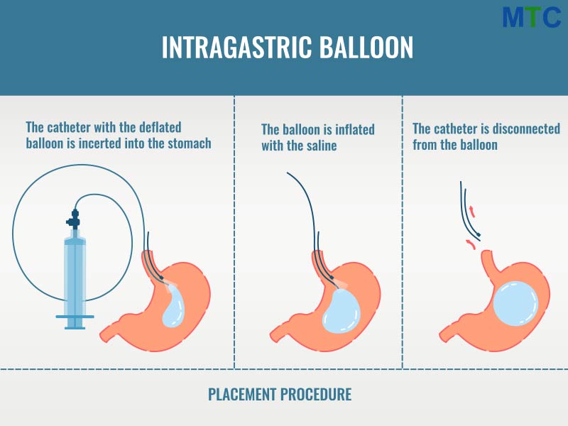 Gastric Balloon