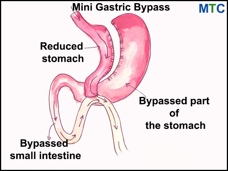 Mini-Gastric-Bypass