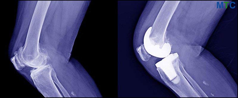 Left: Osteoarthritis. Right: Knee After TKR