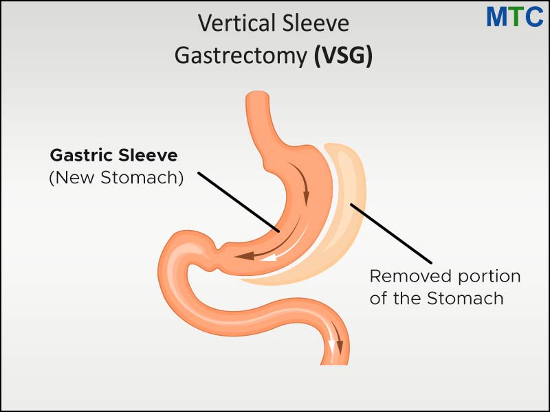 Gastric Sleeve Surgery