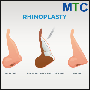 Rhinoplasty in Spain