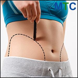 Tummy Tuck