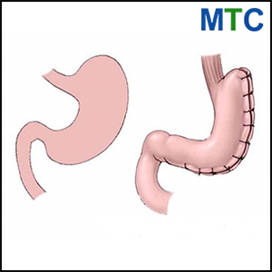 Gastric Plication