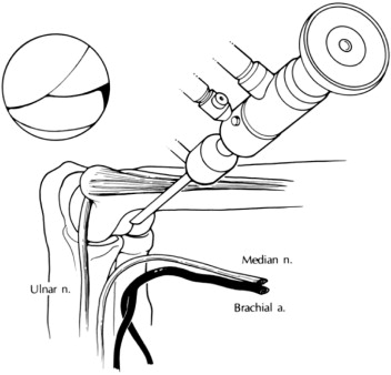 Elbow Arthroscopy in Lithuania