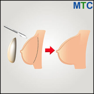 Breast implants in Tijuana