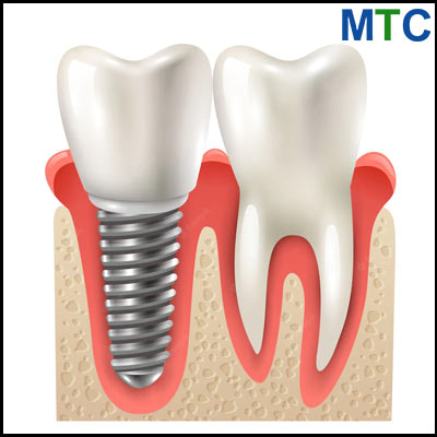 Dental Implants in Phuket, Thailand