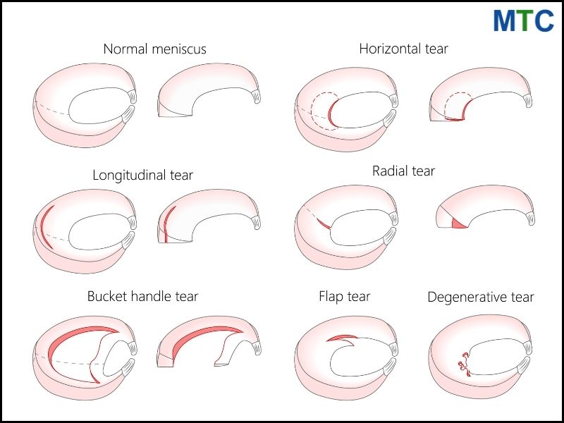 Meniscus Tears